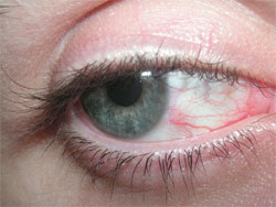 red eye irritation