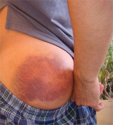 Internal Bleeding Bruises