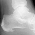 Heel Spur