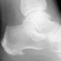 Posterior Calcaneal Spur