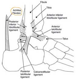 Achilles Tendonitis