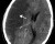 Right Hemispheric Ischemic Stroke