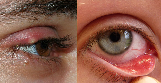 vaseline in eye - Eye Care - MedHelp