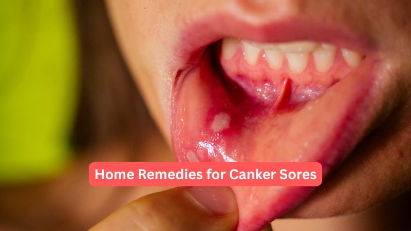 Home Remedies Canker Sores
