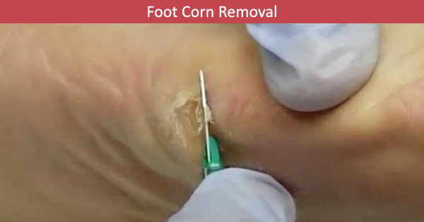 foot corn removal