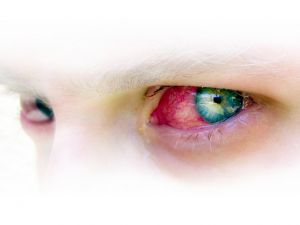 Home Remedies for Conjunctivitis