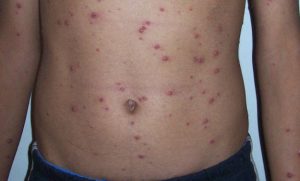 Home Remedies for Chicken Pox - Symptoms of Chicken Pox