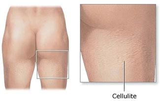 How To Get Rid Of Cellulite On Your Butt