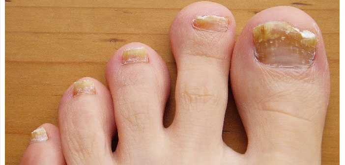 toenail fungus
