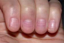 Dents in Fingernails - Causes and How to Prevent Dents in Fingernails