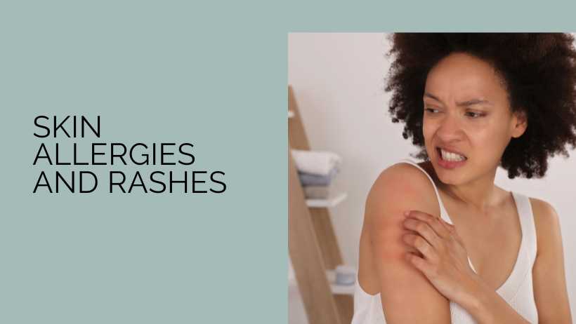 Skin Allergies and Rashes