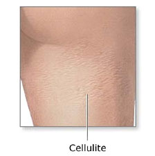 get rid of cellulite