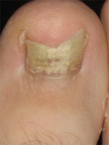 yeast infection toe