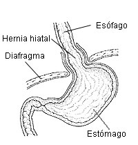 Hiatus Hernia