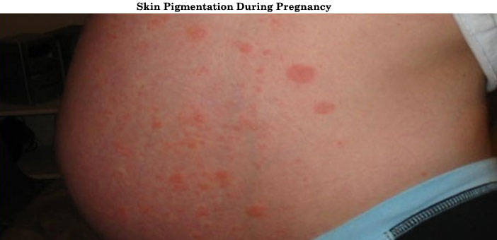 Skin Pigmentation Pregnancy