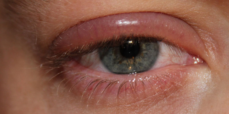 Blepharitis Eye Infection