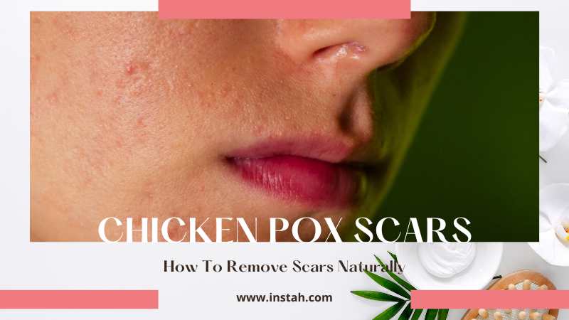 Chicken Pox Scars